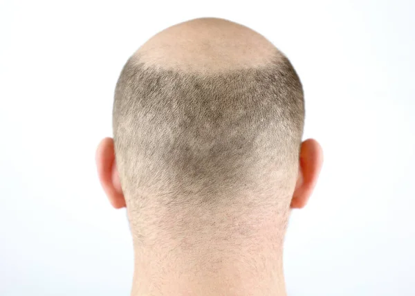はげ男 リアビュー バランスを閉じます 頭の毛の損失 頭を冷やせ 髪の移植 ケアと治療 重度の脱毛症 — ストック写真