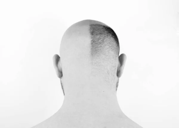 stock image Bald man, rear view. Baldness close-up. Loss of hair on the head. Bald head. Hair transplantation, care and treatment. Severe baldness. Half-shaved head. An unshaven man