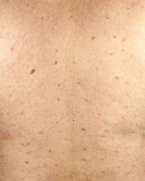 Acne skin. Skin problem. Many acne, shoulders, rear view. Dermatological diseases. Removal of subcutaneous acne