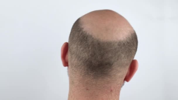 Pria Botak Pandangan Belakang Botak Close Kehilangan Rambut Kepala Anda — Stok Video