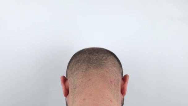 Kel Adam Dikiz Aynasından Kellik Yakın Plan Kafasında Saç Dökülmesi — Stok video