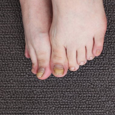 Ayak tırnaklarıyla ilgili sorunlar. Hasarlı başparmak tırnakları. Bacaklarda Mycosis var, parmaktan kopmuş. Pedikür sonrası sorunlar, hastalıktan dolayı parmak tedavisi