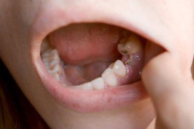 Genç bayan dikişin uygulandığı altıncı dişine bakıyor. Diş tedavisi, bakım. Ortodontik tedavi. Diş yaralarının iyileşmesi.