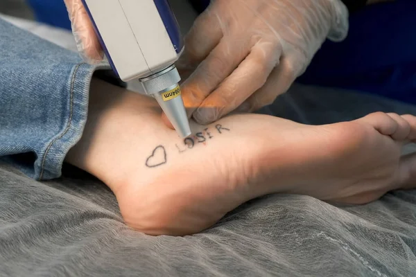 Laser removing of tattoo with words loser, lover and heart on womans foot in red and black colours, closeup hands in gloves of doctor. Romantic tattoo symbol of youth love and disappointment in life.