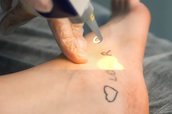 Лазерное Удаление Татуировки Словами Лузер Любовник Сердце Женской Ноге Красных — стоковое фото