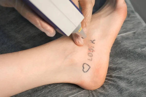 Laser removing of tattoo with words loser, lover and heart on womans foot in red and black colours, closeup hands of doctor in gloves. Romantic tattoo symbol of youth love and disappointment in life.