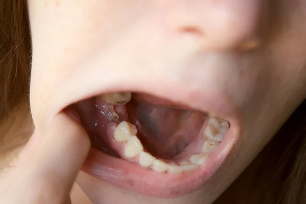 縫合が適用される彼女の削除された第六歯を見ている若い女性 歯科治療 歯列矯正治療だ 歯の傷の治癒 — ストック写真