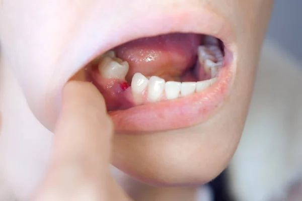 Woman is looking on her removed sixth tooth with an inflamed gum, closeup view inside of mouth. Dental treatment, care. Orthodontic cure. Healing of dental wounds.