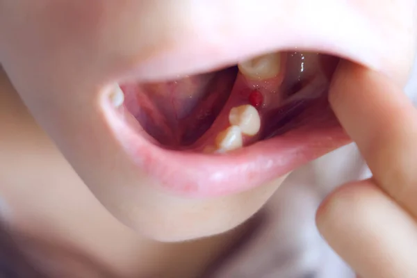 Женщина Смотрит Удалённый Шестой Зуб Воспалённой Жвачкой Близкого Расстояния Рту — стоковое фото