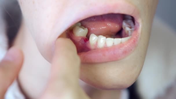 女性は口の中で炎症を起こしたガムで彼女の除去第六歯を探しています クローズアップビュー 歯科治療 歯列矯正治療だ 歯の傷の治癒 — ストック動画