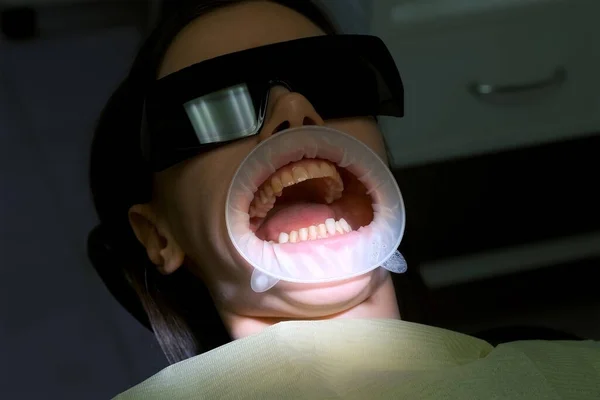 Примерка Белого Шпона Женских Желтых Зубах Перед Установкой Стоматологии Протезирование — стоковое фото