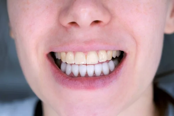 Zęby Kobiety Białymi Okleinami Dole Żółtymi Górnymi Zębami Zbliżenie Ust — Zdjęcie stockowe