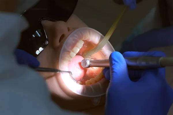 Стоматолог Готує Жіночі Зуби Установки Керамічних Вінірів Коронок Допомогою Дрилі — стокове фото