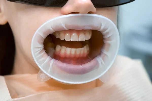 Mulher Com Dentes Amarelos Com Retrator Boca Está Esperando Dentista — Fotografia de Stock
