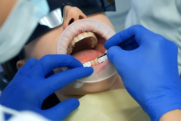 Стоматолог Готує Жіночі Зуби Установки Керамічних Вінірів Коронок Він Наносить Ліцензійні Стокові Зображення