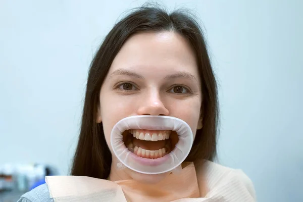 Портрет Счастливой Женщины Жёлтыми Зубами Ретрактором Рту Ждет Стоматолога Стоматологии Стоковое Изображение