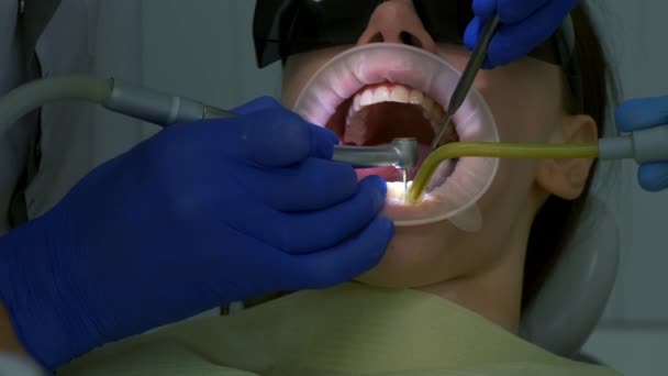 Dentist Preparing Womans Teeth Installing Ceramic Veneers Crowns Using Drill — Stock Video