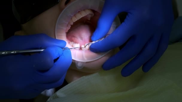 歯医者は患者の歯と歯茎の間の出血を止めるために糸を置きます 歯科治療の過程で口腔のクローズアップ 義肢の概念 整形外科医の治療 — ストック動画