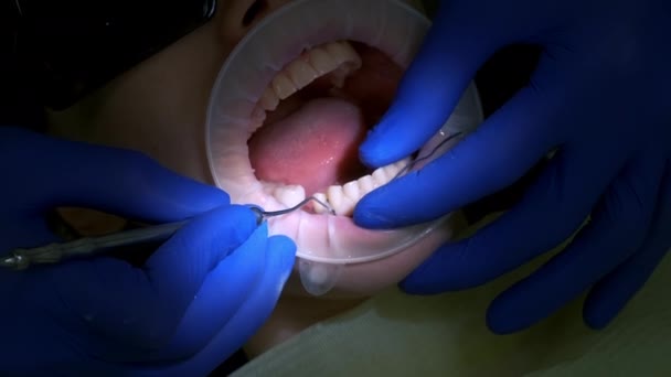 Οδοντίατρος Βάζει Νήμα Για Σταματήσει Αιμορραγία Μεταξύ Δοντιών Και Ούλων — Αρχείο Βίντεο