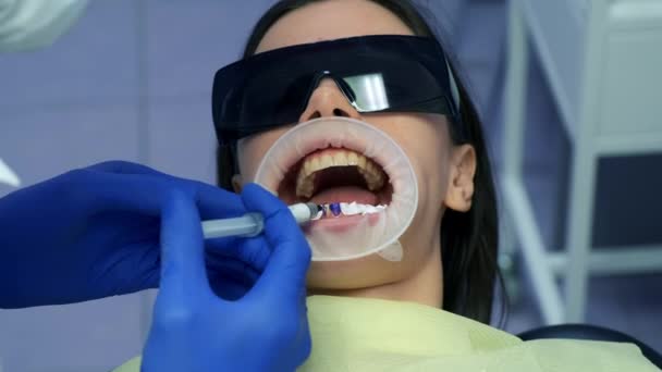 牙科医生在女牙上涂蓝色酸 然后再安装牙龈和陶瓷冠 牙科治疗 病人准备 假牙的概念 牙齿矫正疗法 — 图库视频影像