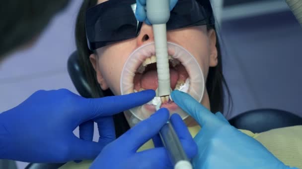 牙科医生正在把妇女牙齿中的蓝色酸洗掉 然后再安装镶嵌的陶瓷牙冠 牙科治疗 假牙的概念 牙齿矫正疗法 — 图库视频影像