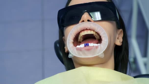 Ácido Azul Nos Dentes Das Mulheres Antes Instalar Folheados Coroas — Vídeo de Stock