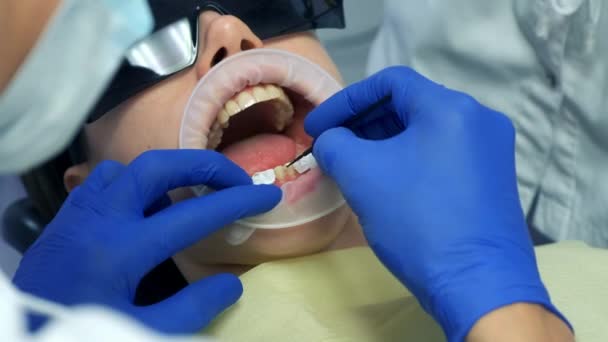 Dentysta Przygotowuje Kobiece Zęby Montażu Ceramicznych Oklein Koron Nałożył Płyn — Wideo stockowe