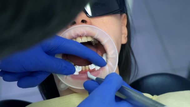 牙科医生正在准备妇女的牙齿 以安装陶瓷镶嵌器和牙冠 他在用烘干机擦干她的牙 牙科治疗 假牙的概念 牙齿矫正疗法 — 图库视频影像
