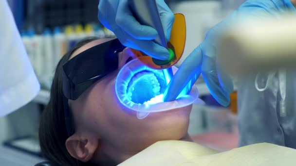 Стоматолог Устанавливает Женский Шпон Керамические Коронки Зубах Используя Ультрафиолетовую Лампу — стоковое видео