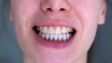 Dişleri beyaz kaplamalı ve üst sarı dişli, ağzı kapalı bir kadın. Kozmetik stomatoloji dişçilik konsepti. Genç bir kadının Malocclusion 'ı.
