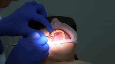 Diş hekimi, hastanın diş eti ve sakızı arasındaki kanamayı durdurmak için ipliği yerleştiriyor. Diş tedavisi sırasında ağız boşluğuna yakın çekim yapılmış. Dişçilik, protez konsepti. Ortodontist tedavisi.