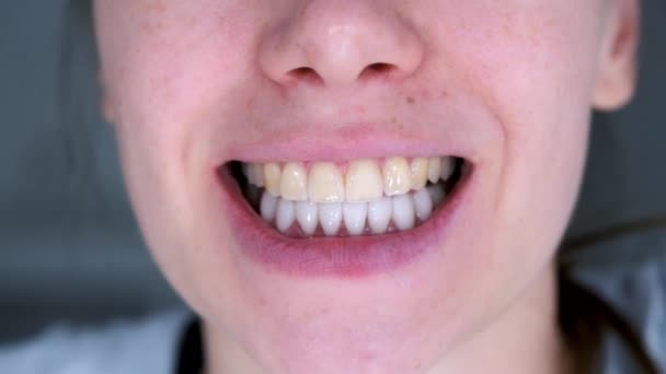 牙齿的女人 下部有白色的牙和黄色的上牙 嘴的特写 整形外科口腔科概念 对一名年轻妇女的排斥 — 图库视频影像