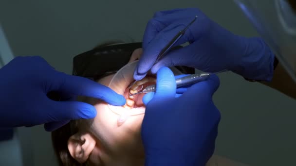 牙科医生用螺纹止住病人牙齿和牙龈之间的出血 在口腔治疗过程中对口腔进行近距离观察 假肢的概念 牙齿矫正疗法 — 图库视频影像