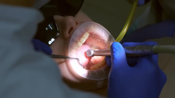 牙科医生正在准备妇女的牙齿 以便用钻头安装陶瓷饰物和牙冠 他正在部分去除牙齿上的牙釉质 假肢的概念 牙齿矫正师的治疗 — 图库视频影像