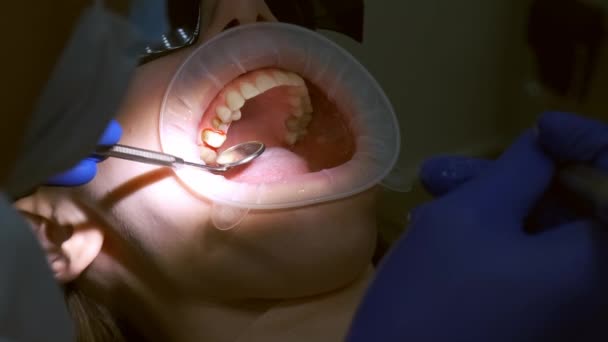 Dentysta Przygotowuje Kobiece Zęby Montażu Oklein Ceramicznych Usuwających Szkliwo Stomatologia — Wideo stockowe