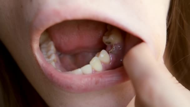 Νεαρή Γυναίκα Κοιτάζει Έκτο Δόντι Της Στο Οποίο Εφαρμόζεται Ράμμα — Αρχείο Βίντεο