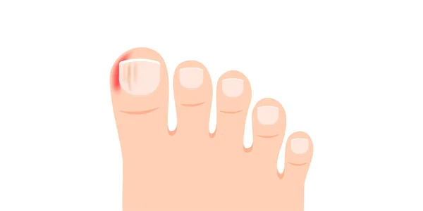 Swollen Toe Cartoon Vector Person Feet Nail Disease Infection Foot — Stock Vector