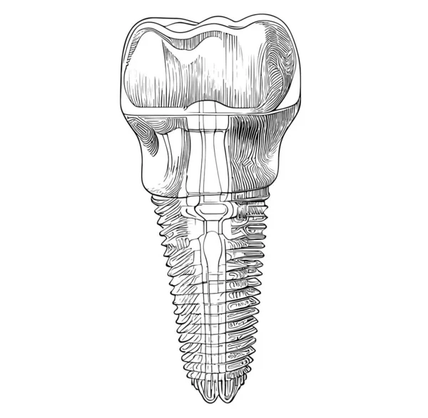 Zahnimplantat Zahnmedizin Skizze Handgezeichnete Skizze Gravur Stil Vektor Illustration — Stockvektor