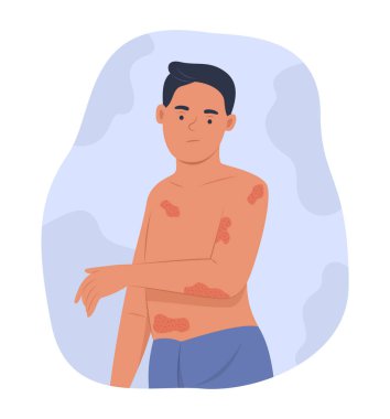 Man with Atopic Dermatitis or Eczema on Body clipart