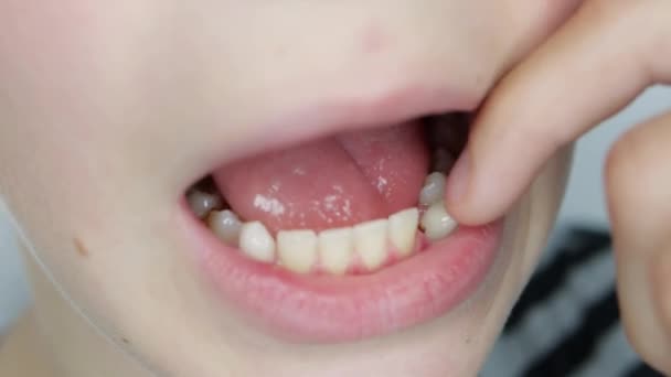 Zbliżenie Dziecięcego Zęba Zaraz Wypadnie Wysokiej Jakości Materiał — Wideo stockowe