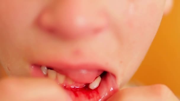 家里哭哭啼啼的男孩在浴室拔出一颗松动的牙 优质Fullhd影片 — 图库视频影像