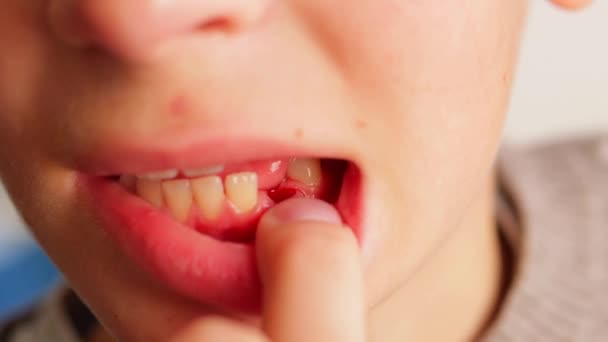 Chłopiec Płacze Odczuwa Lekki Ból Tym Jak Wyrwano Przedni Ząb — Wideo stockowe