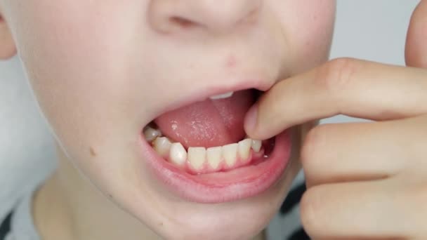 Nahaufnahme Von Babys Zahn Ist Bereit Herausfallen Hochwertiges Filmmaterial — Stockvideo
