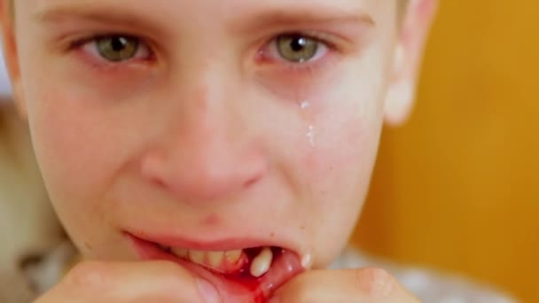 Хлопчик Плаче Відчуває Невеликий Біль Після Його Передній Зуб Витягнули — стокове відео