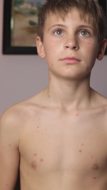 Menino Com Varíola Seu Corpo — Vídeo de Stock