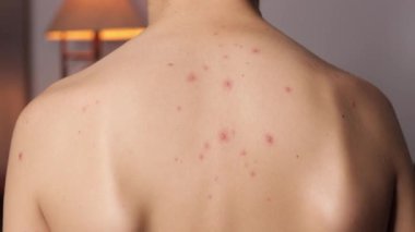 Sırtında frengi hastalığı olan genç bir kadın, frengili, frengili, frengili, frengili, virüslü, kaşıntılı hasta bir adam.,