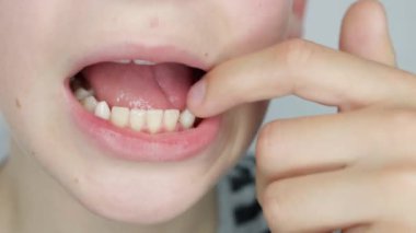Çocuk dokunur, parmaklarıyla titrer yamuk bir süt dişi, çocukların ağzının makro görüntüsü. Diş kaybı kavramı, bebek dişini çıkarma süreci. Seçici odaklanma. Yüksek kalite 4k görüntü