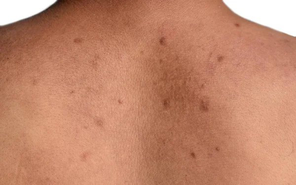 Black spots and scars on the back of Asian, Myanmar man