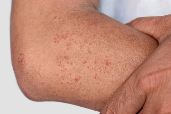 Mehrere Juckende Stechmücken Oder Insektenstiche Rote Flecken Auf Dem Unterarm — Stockfoto