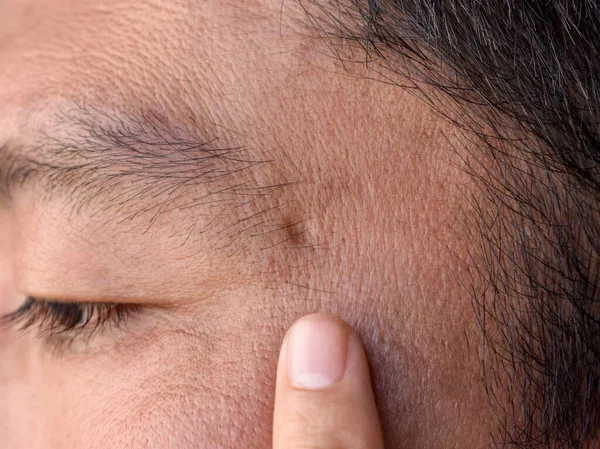 Einzelne Akne Narbe Auf Dem Gesicht Eines Asiatischen Chinesen — Stockfoto